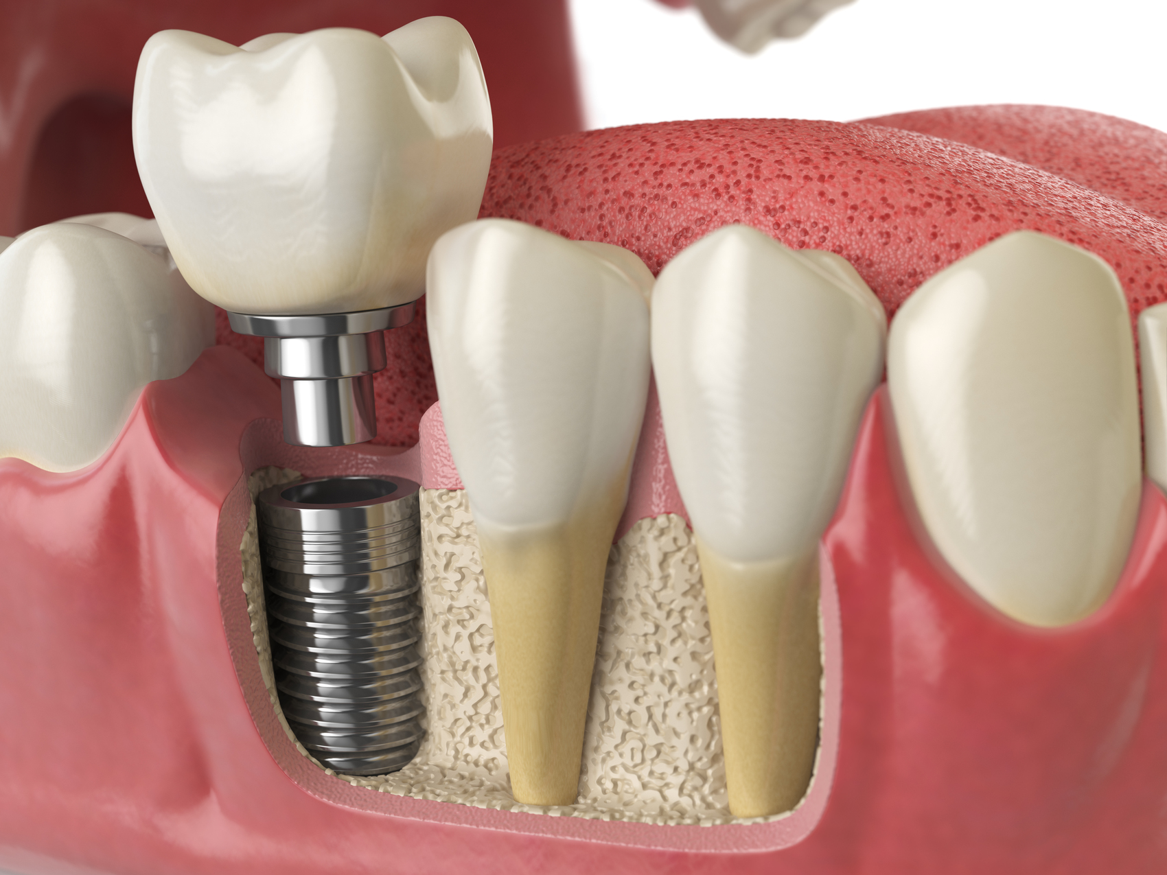 sermadent-news-item-preguntas-frecuentes-sobre-implantes-dentales-lo-que-debes-saber-antes-de-comenzar-tu-tratamiento-en-fuengirola