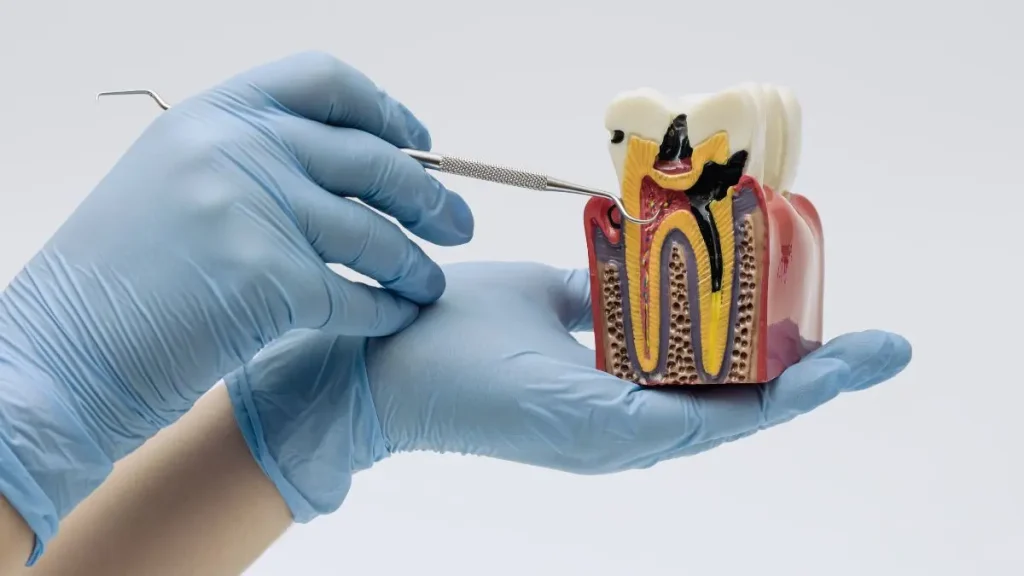 Modelo dental que muestra la anatomía interna y los conductos de una muela
